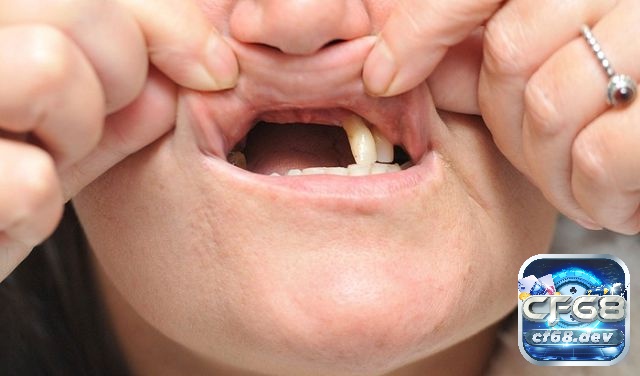 Mơ thấy rụng răng là điềm báo gì? Giải mã các con số may mắn Mơ thấy rụng nhiều răng cùng lúc biểu thị mạnh cho những thay đổi lớn hoặc khó khăn trong cuộc sống.
