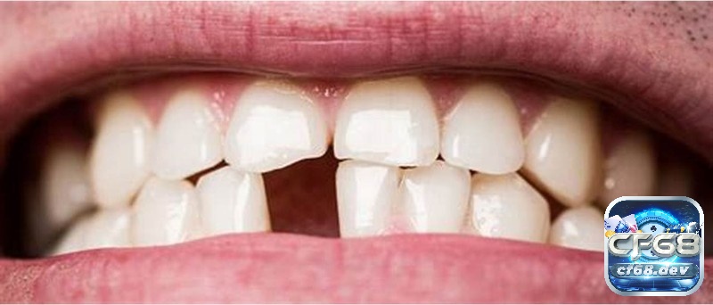 Nằm mơ thấy rụng răng điềm báo gì? Điềm báo lành hay gỡ? Mơ thấy rụng răng dưới tượng trưng cho sự diễn đạt, truyền cảm xúc gặp khó khăn