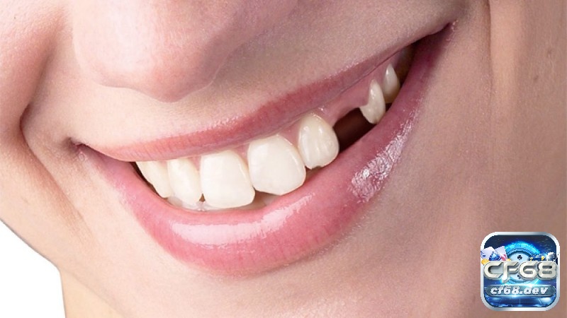 Mơ gãy răng báo điềm gì: Giải mã tổng quát mơ thấy gãy răng Giấc mơ bị gãy răng cửa thường phản ánh sự bất an về hình ảnh bản thân hoặc những áp lực trong các mối quan hệ xã hội mà bạn muốn cải thiện.